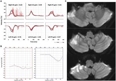 Bilaterally positive head-impulse tests can differentiate AICA infarction from labyrinthitis